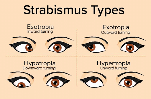 Types of Strabismus diagram